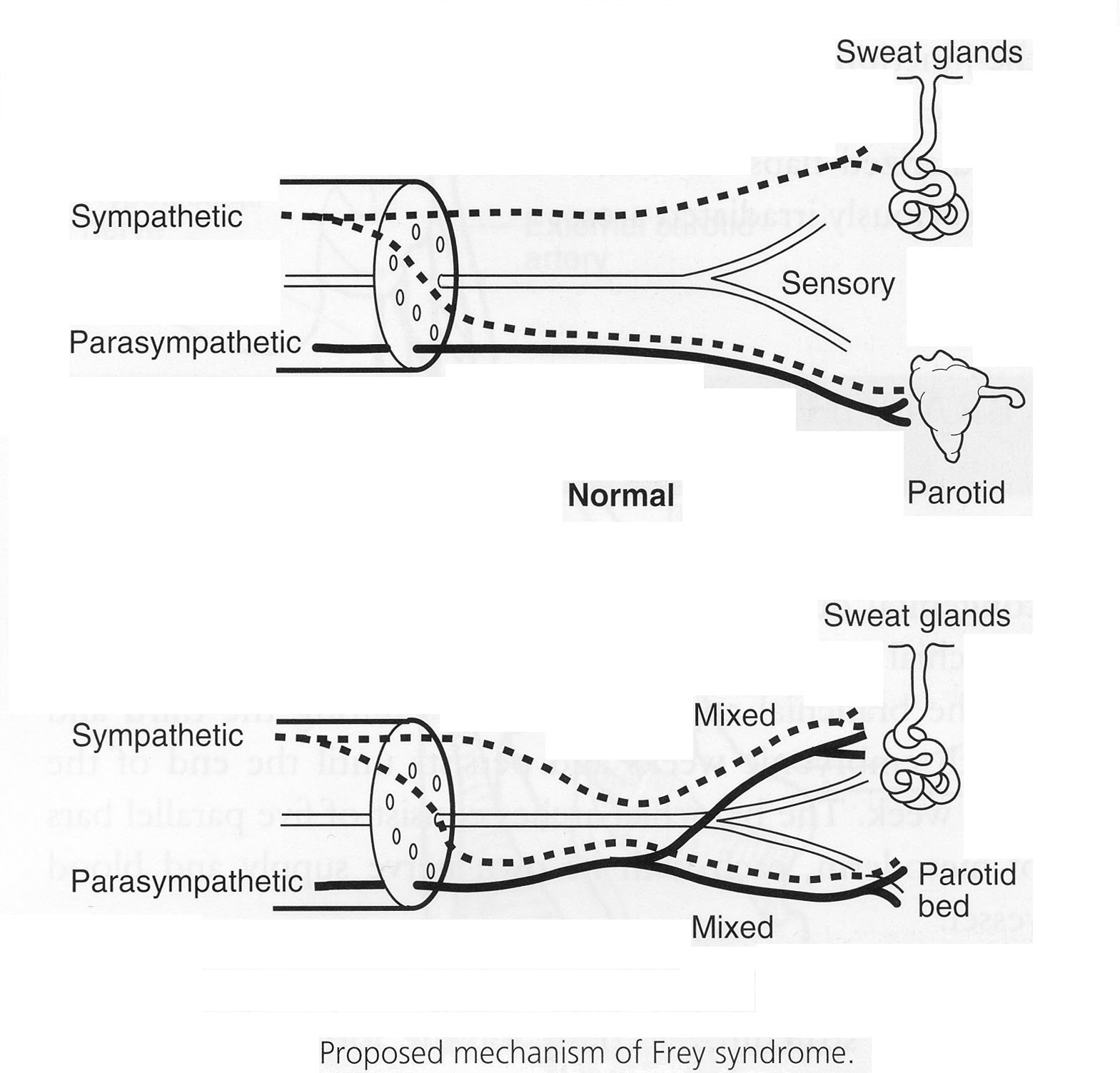 Frey’s Syndrome / Gustatory Sweating37